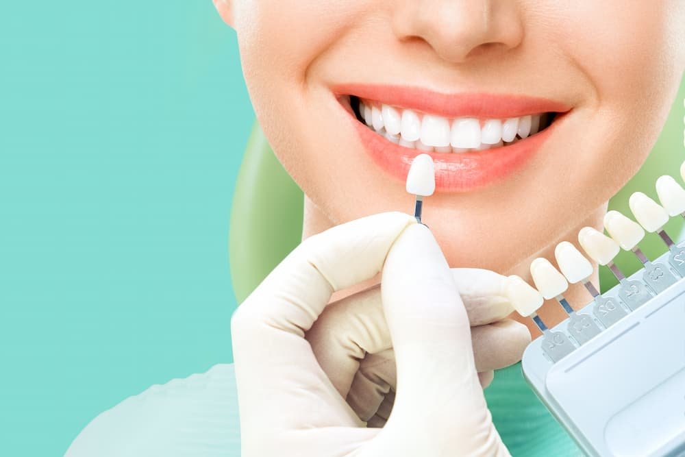 veneers img (2)